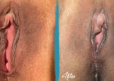 vaginal rejuvenation before and after photo by mona hardas md cosmetic gynecology in flint mi