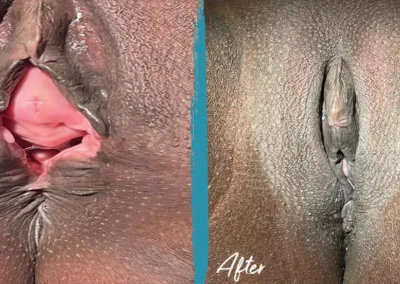 vaginal rejuvenation before and after photo by mona hardas md cosmetic gynecology in flint mi