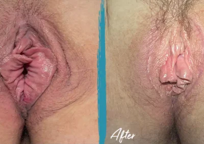 vaginal rejuvenation before and after photo by mona hardas md cosmetic gynecology in flint mi