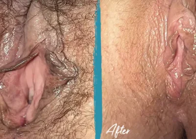 vaginal rejuvenation before and after photo by mona hardas md cosmetic gynecology in flint mi
