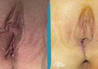 vaginal rejuvenation before and after photo by mona hardas md cosmetic gynecology in flint mi