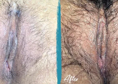 vaginal rejuvenation before and after photo by mona hardas md cosmetic gynecology in flint mi