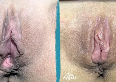 vaginal rejuvenation before and after photo by mona hardas md cosmetic gynecology in flint mi