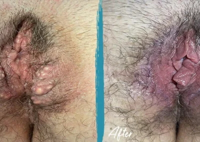 vaginal rejuvenation before and after photo by mona hardas md cosmetic gynecology in flint mi