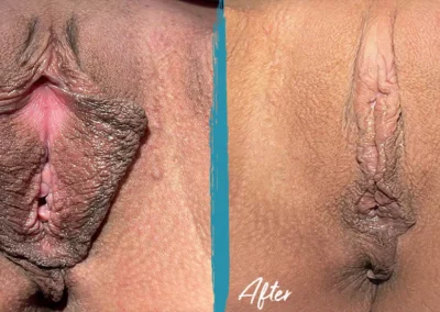 vaginal rejuvenation before and after photo by mona hardas md cosmetic gynecology in flint mi