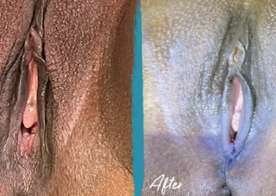 vaginal rejuvenation before and after photo by mona hardas md cosmetic gynecology in flint mi