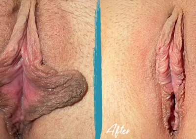vaginal rejuvenation before and after photo by mona hardas md cosmetic gynecology in flint mi
