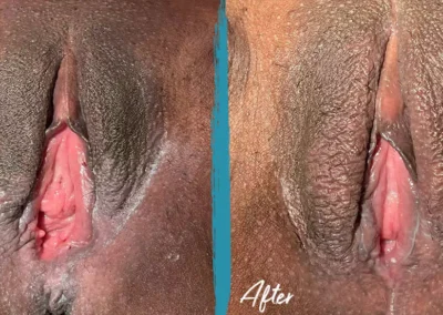 vaginal rejuvenation before and after photo by mona hardas md cosmetic gynecology in flint mi