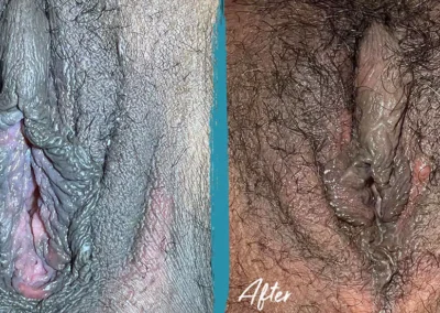 vaginal rejuvenation before and after photo by mona hardas md cosmetic gynecology in flint mi