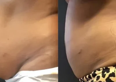liposuction before and after photo by mona hardas md cosmetic gynecology in flint mi