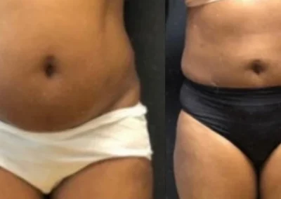 liposuction before and after photo by mona hardas md cosmetic gynecology in flint mi