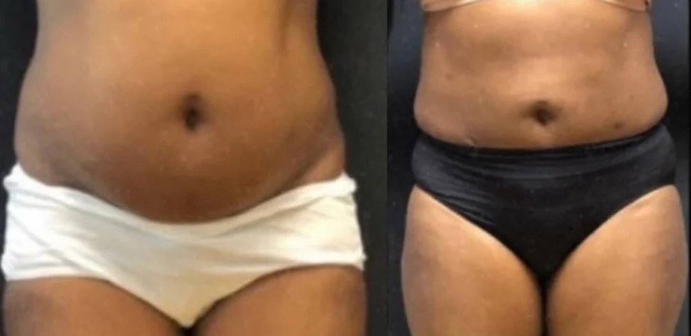 liposuction before and after photo by mona hardas md cosmetic gynecology in flint mi liposuction before and after photo by mona hardas md cosmetic gynecology in flint mi