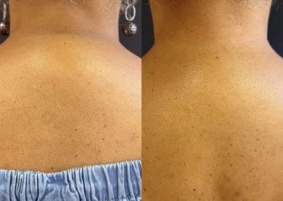 kybella before and after photo by mona hardas md cosmetic gynecology in flint mi