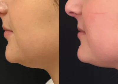 kybella before and after photo by mona hardas md cosmetic gynecology in flint mi