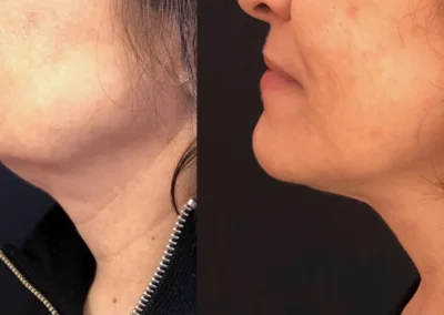kybella before and after photo by mona hardas md cosmetic gynecology in flint mi