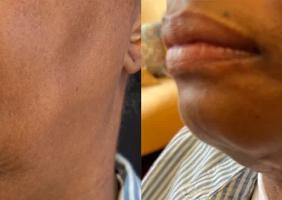 kybella before and after photo by mona hardas md cosmetic gynecology in flint mi