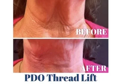 PDO thread lift before and after photo by mona hardas md cosmetic gynecology in flint mi