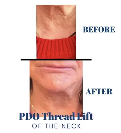 PDO thread lift before and after photo by mona hardas md cosmetic gynecology in flint mi