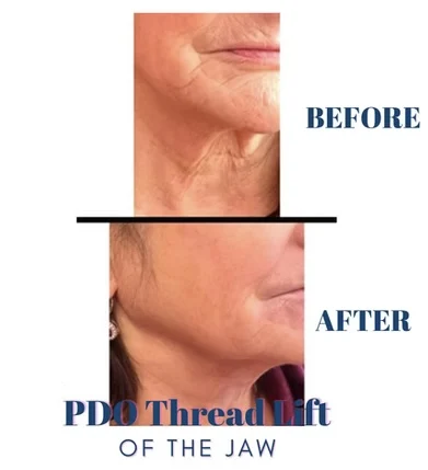 PDO thread lift before and after photo by mona hardas md cosmetic gynecology in flint mi