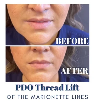 PDO thread lift before and after photo by mona hardas md cosmetic gynecology in flint mi