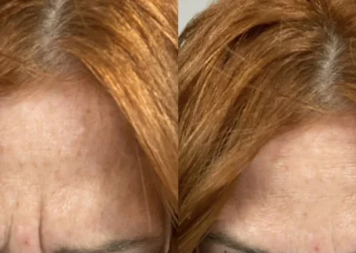 botox and fillers before and after photo by mona hardas md cosmetic gynecology in flint mi