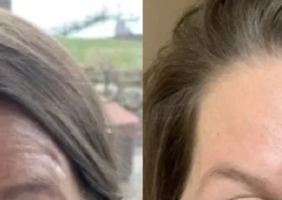 botox and fillers before and after photo by mona hardas md cosmetic gynecology in flint mi