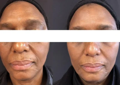 botox and fillers before and after photo by mona hardas md cosmetic gynecology in flint mi
