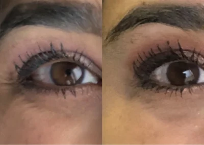 botox and fillers before and after photo by mona hardas md cosmetic gynecology in flint mi