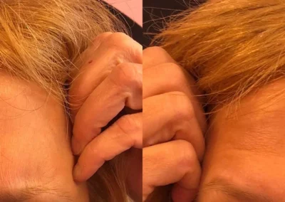 botox and fillers before and after photo by mona hardas md cosmetic gynecology in flint mi