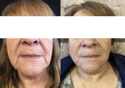 botox and fillers before and after photo by mona hardas md cosmetic gynecology in flint mi