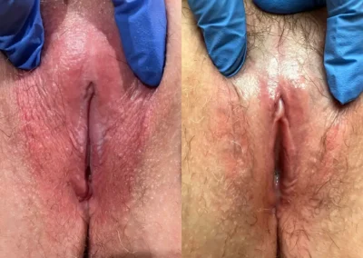 clitoral unhooding before & after