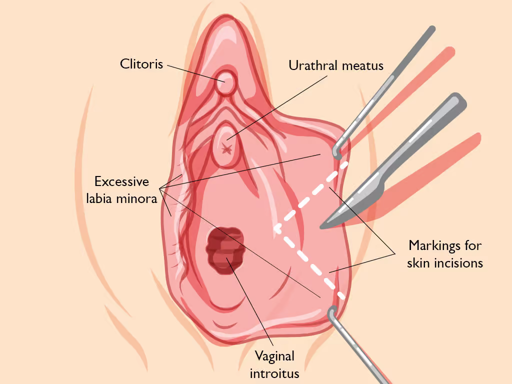 Intraoperative Procedure in Michigan