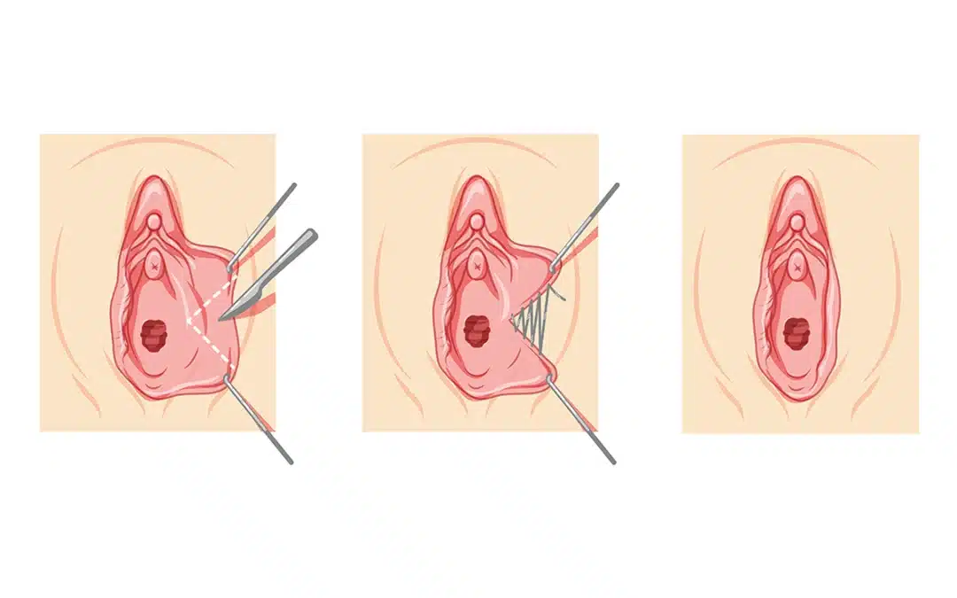 labiaplasty female reproductive system process and ready uterus