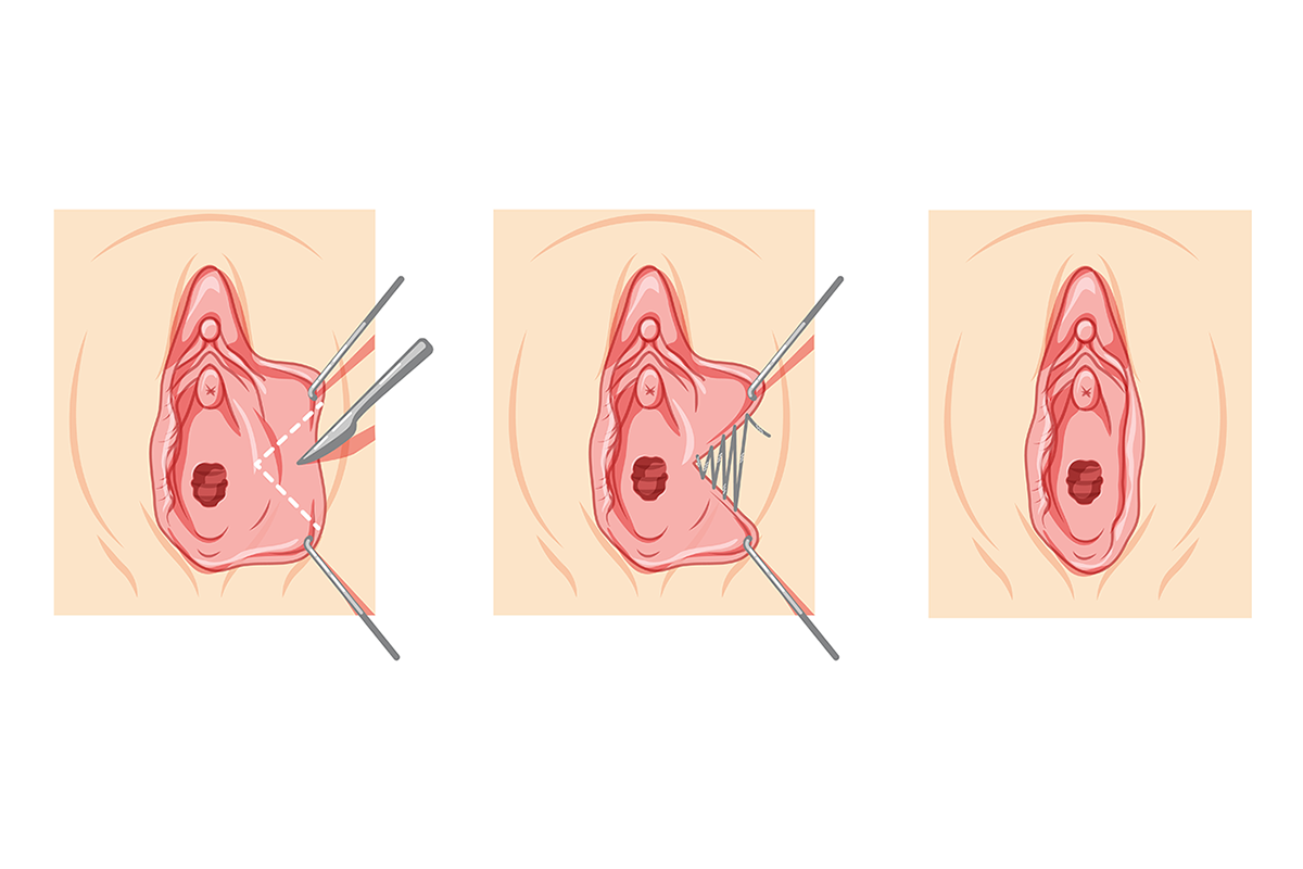 labiaplasty female reproductive system process and ready uterus