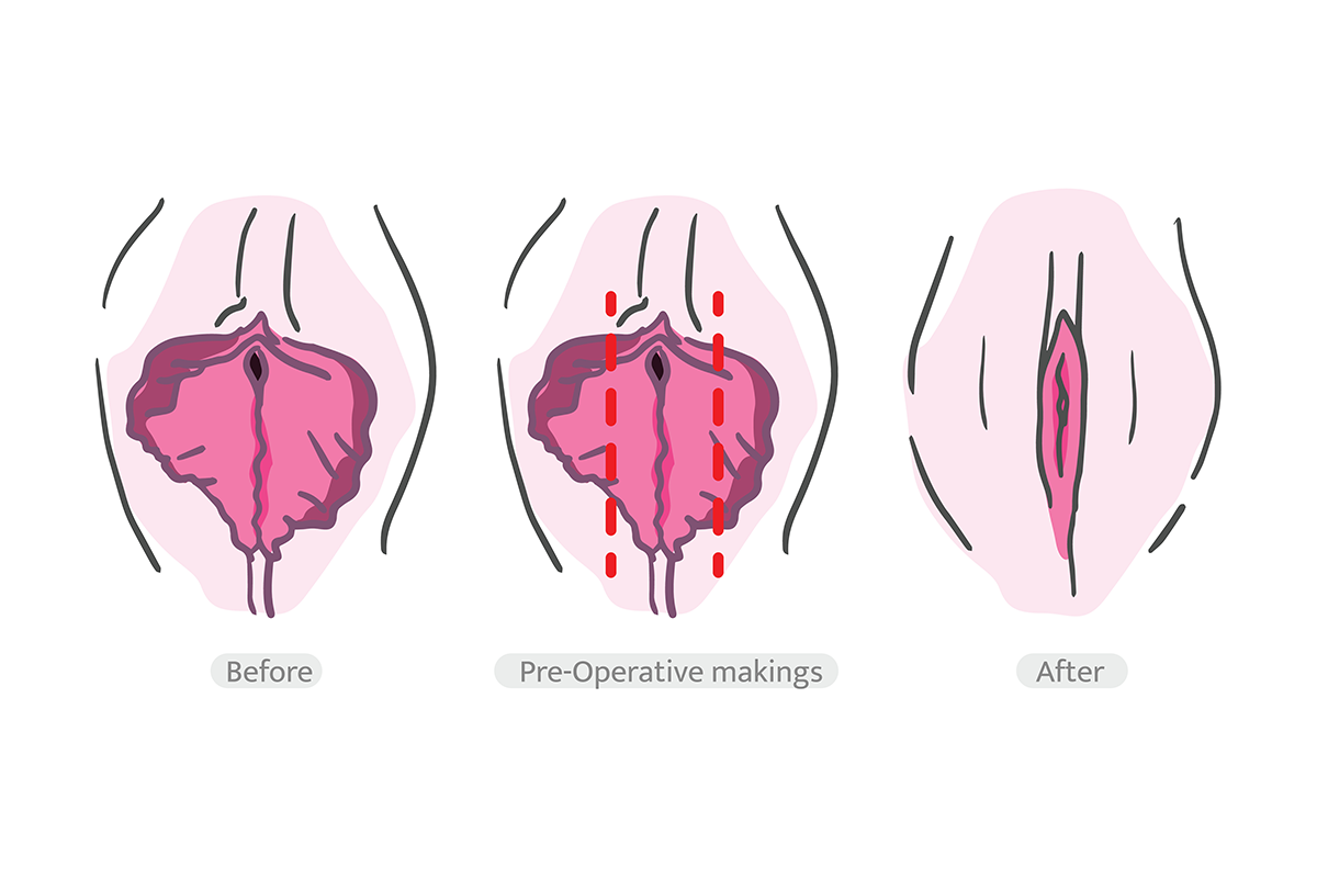 labiaplasty surgery techniques