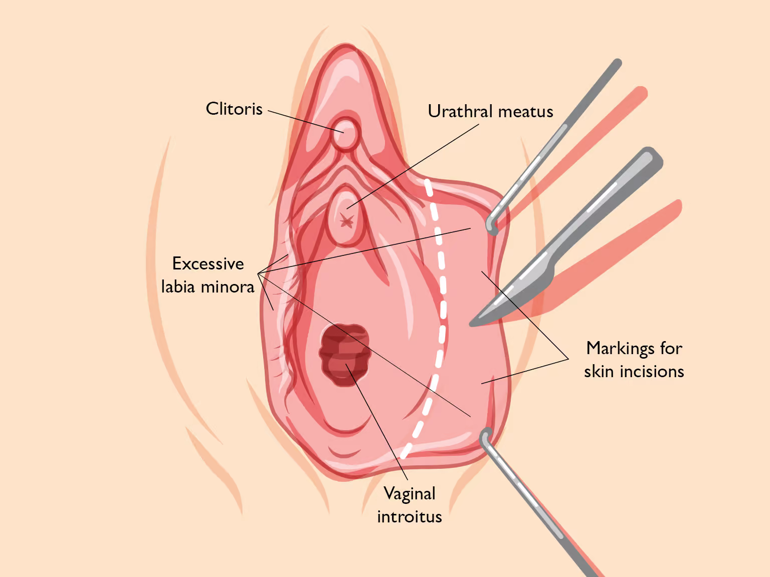Procedure for the Trim Labiaplasty Technique in Michigan