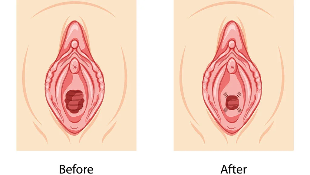 Surgical Treatments for Vaginal Rejuvenation