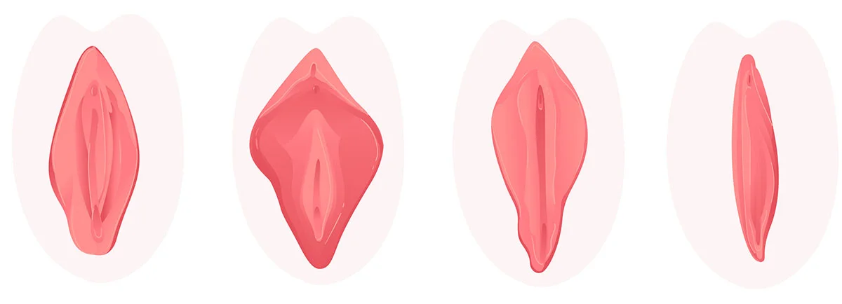 What Does Not Count As A Labiaplasty