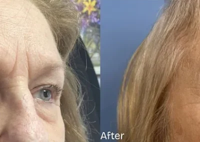 prp under eyes before and after photo by mona hardas md cosmetic gynecology in flint mi