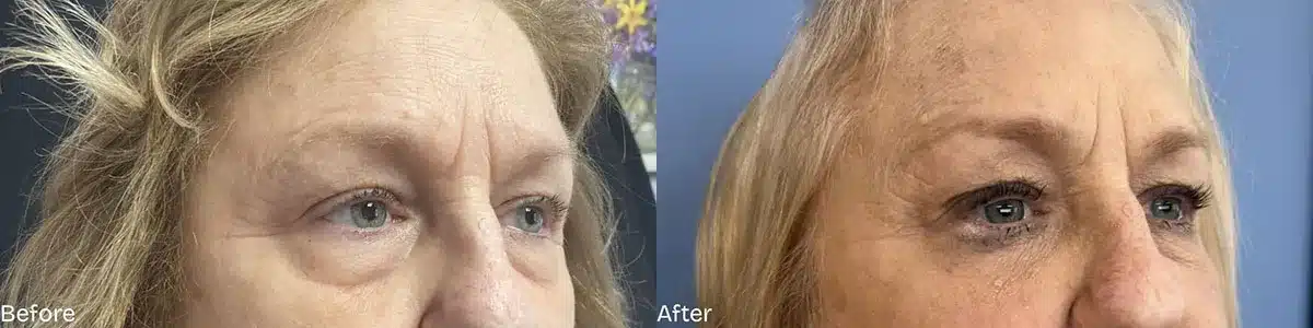 prp under eyes before and after photo by mona hardas md cosmetic gynecology in flint mi