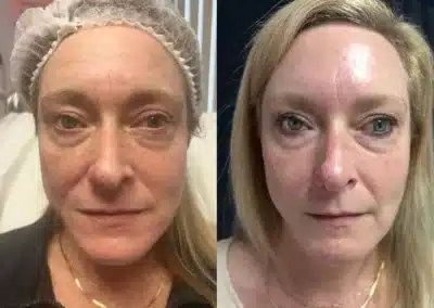 Morpheus before and after photo by mona hardas md cosmetic gynecology in flint mi