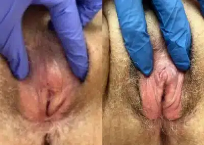 clitoral unhooding before and after photo by mona hardas md cosmetic gynecology in flint mi