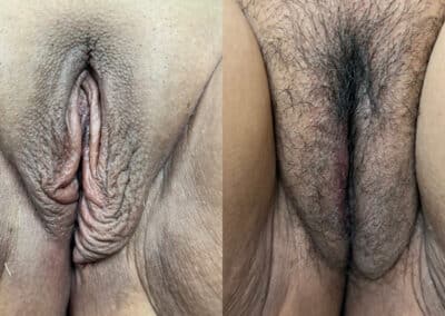 labia fat transfers before and after photo by mona hardas md cosmetic gynecology in flint mi