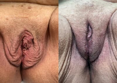 labia fat transfers before and after photo by mona hardas md cosmetic gynecology in flint mi